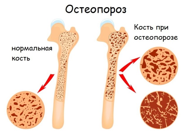 остеопороз