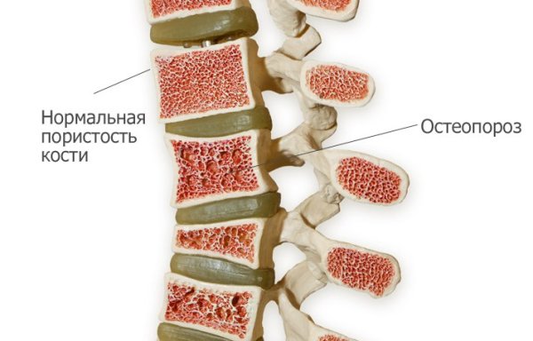 остеопороз позвоночника 