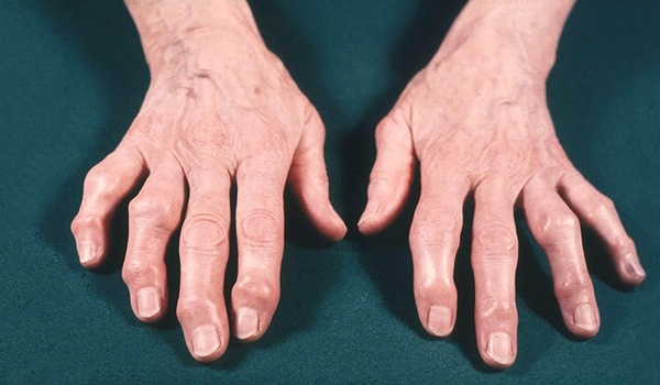 артрит рук