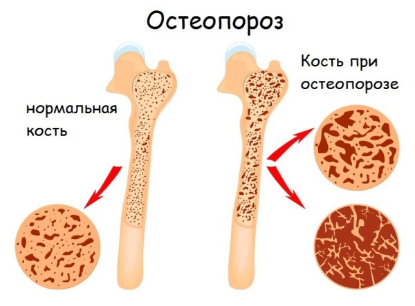 Изображение - Болезни костей и суставов ног bolezni-kostey-1