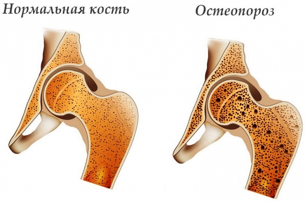 диффузный остеопороз