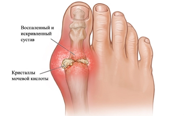 Артроз плюснефалангового сустава 1 пальца стопы: симптомы и лечение