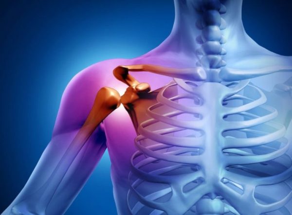 остеоартроз плечевого сустава 
